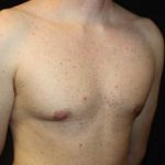 Gynecomastia Before & After Patient #23330