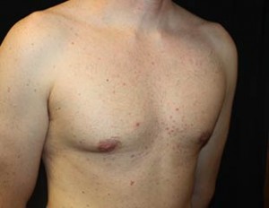 Gynecomastia Before & After Patient #23330