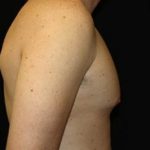 Gynecomastia Before & After Patient #23330