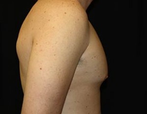 Gynecomastia Before & After Patient #23330