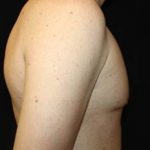 Gynecomastia Before & After Patient #23330