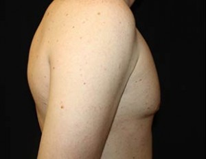 Gynecomastia Before & After Patient #23330