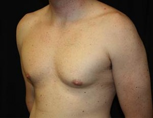 Gynecomastia Before & After Patient #23330