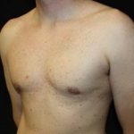 Gynecomastia Before & After Patient #23330