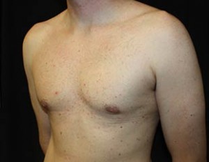 Gynecomastia Before & After Patient #23330