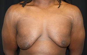 Gynecomastia Before & After Patient #23339