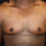 Gynecomastia Before & After Patient #23339