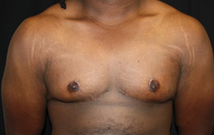 Gynecomastia Before & After Patient #23339