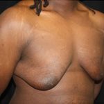 Gynecomastia Before & After Patient #23339