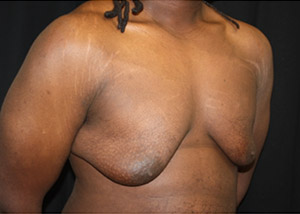 Gynecomastia Before & After Patient #23339