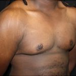 Gynecomastia Before & After Patient #23339