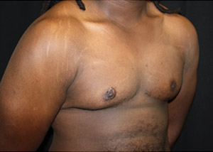 Gynecomastia Before & After Patient #23339