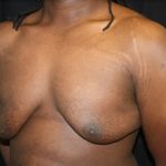 Gynecomastia Before & After Patient #23339