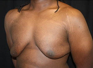 Gynecomastia Before & After Patient #23339