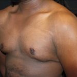 Gynecomastia Before & After Patient #23339