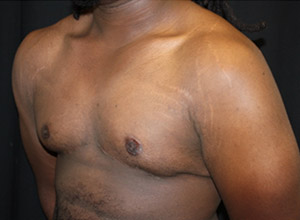 Gynecomastia Before & After Patient #23339