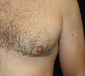 Gynecomastia Before & After Patient #23295