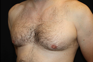 Gynecomastia Before & After Patient #23295