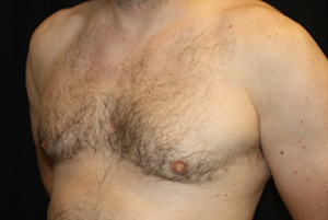 Gynecomastia Before & After Patient #23295