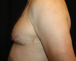 Gynecomastia Before & After Patient #23295