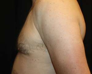 Gynecomastia Before & After Patient #23295