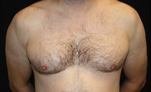 Gynecomastia Before & After Patient #23295