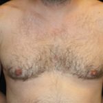 Gynecomastia Before & After Patient #23295