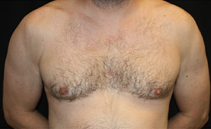 Gynecomastia Before & After Patient #23295