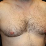 Gynecomastia Before & After Patient #23295