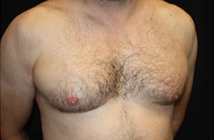 Gynecomastia Before & After Patient #23295