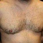 Gynecomastia Before & After Patient #23295