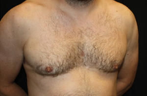 Gynecomastia Before & After Patient #23295