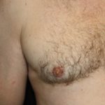 Gynecomastia Before & After Patient #23295