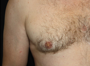 Gynecomastia Before & After Patient #23295