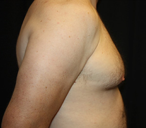 Gynecomastia Before & After Patient #23295