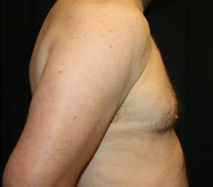 Gynecomastia Before & After Patient #23295