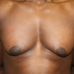 Gynecomastia Before & After Patient #23415