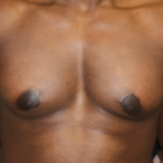 Gynecomastia Before & After Patient #23415