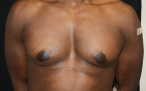 Gynecomastia Before & After Patient #23415