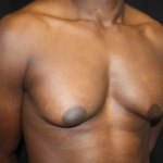 Gynecomastia Before & After Patient #23415