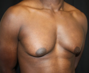 Gynecomastia Before & After Patient #23415