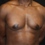 Gynecomastia Before & After Patient #23415