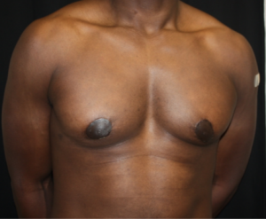 Gynecomastia Before & After Patient #23415