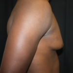 Gynecomastia Before & After Patient #23415