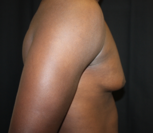 Gynecomastia Before & After Patient #23415