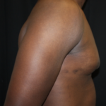 Gynecomastia Before & After Patient #23415