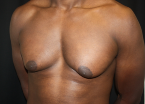 Gynecomastia Before & After Patient #23415