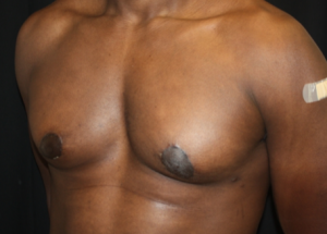 Gynecomastia Before & After Patient #23415