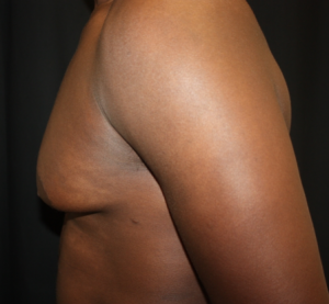 Gynecomastia Before & After Patient #23415