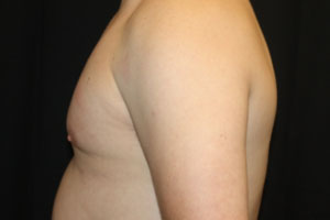 Gynecomastia Before & After Patient #21222